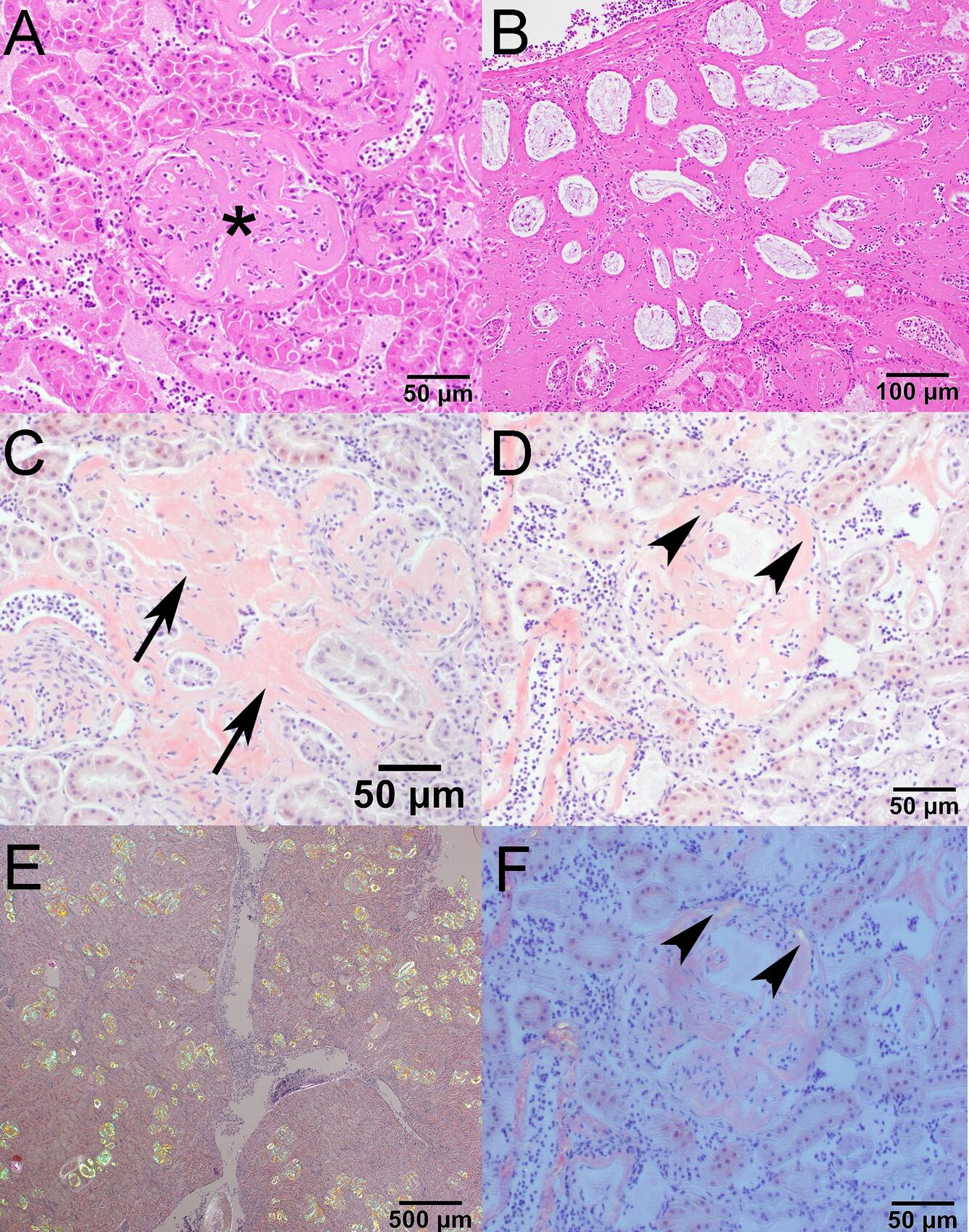 Photomicrographs from a Mallard Duck with amyloidosis